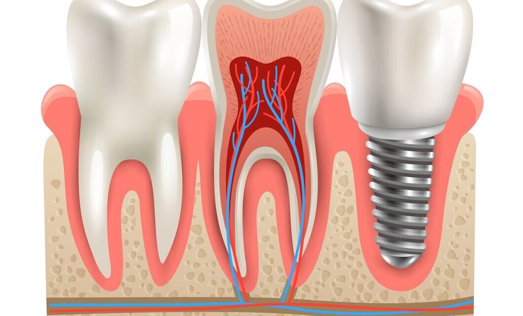 L’Importance des Implants Dentaires : Avantages, Types et Techniques